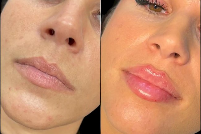 Dermal Fillers in Dubai for a Fresh and Radiant Look