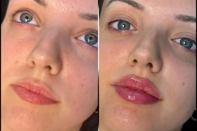 Best Aesthetic Clinic in Dubai for Fillers: Trusted by Beauty Experts