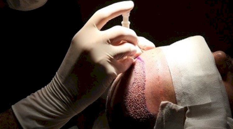 Best Hair Transplant Clinics Near Islamabad’s Medical Centers