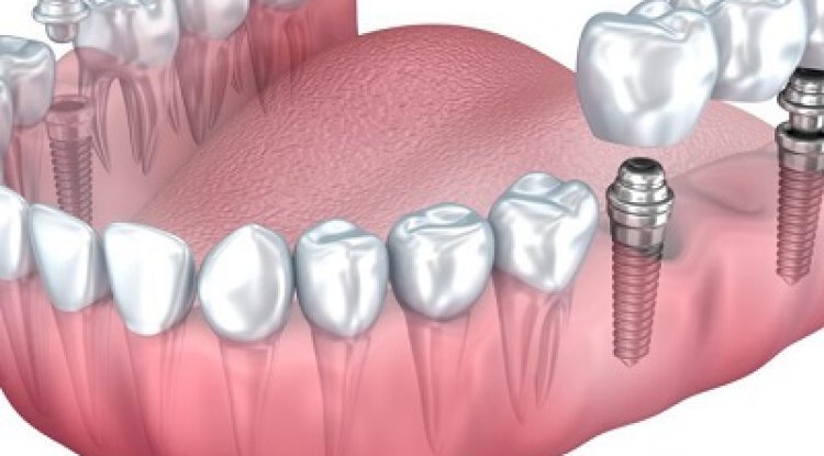 Common Misconceptions About Dental Implants