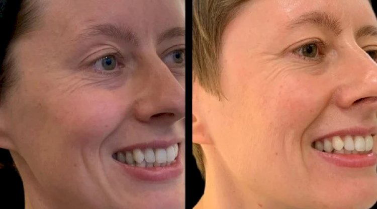 How the Best Doctors in Dubai Are Combining Profhilo with Other Treatments for Maximum Results