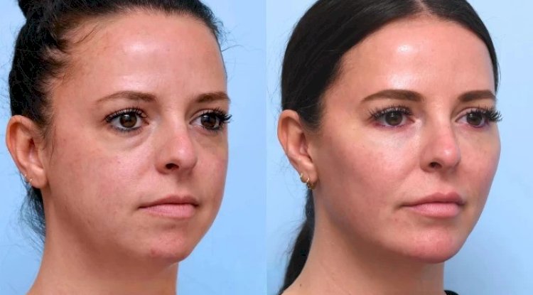 How to Find the Best Doctors in Dubai for a Non-Surgical Thread Lift
