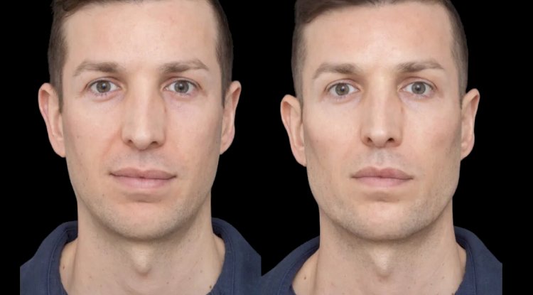 The Best Aesthetic Clinic in Dubai: Home to Top Cheek Filler Experts