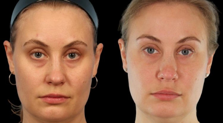 The Process of Under Eye Fillers at the Best Aesthetic Clinic in Dubai