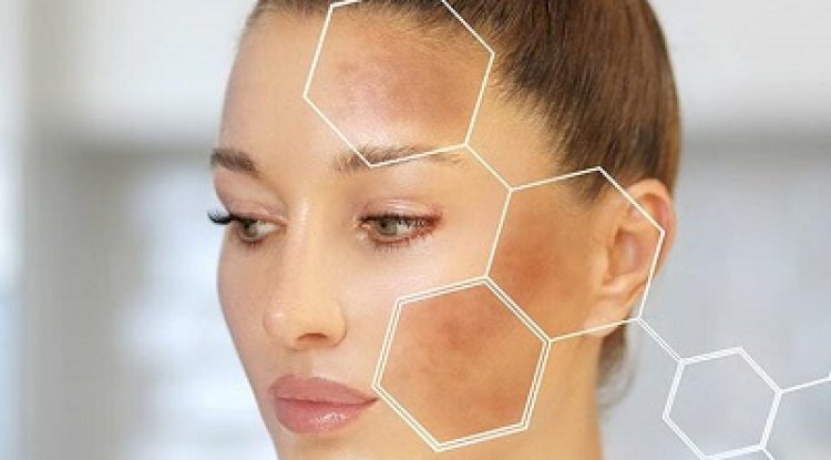 Pros and Cons of Natural vs Medical Melasma Treatments in Islamabad