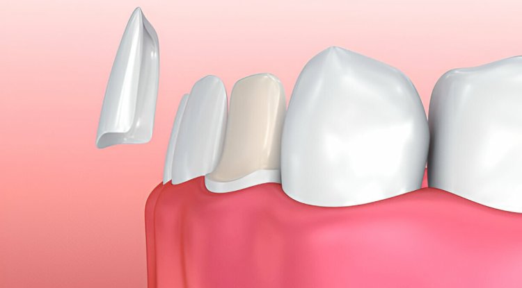 Everything You Need to Know About Porcelain Veneers at Gentle Dentistry of Las Colinas in Irving, TX