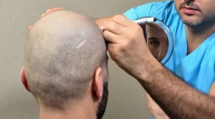 Hair Transplant in Dubai 2025: Your Comprehensive Guide to Modern Hair Restoration