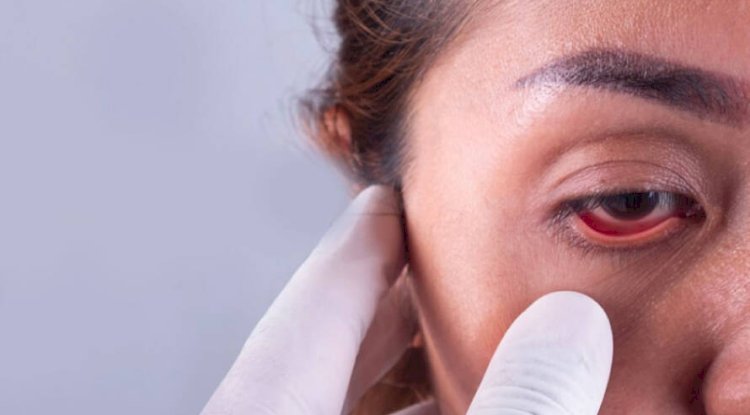 Natural Ayurvedic Solutions for Managing Glaucoma Without Surgery