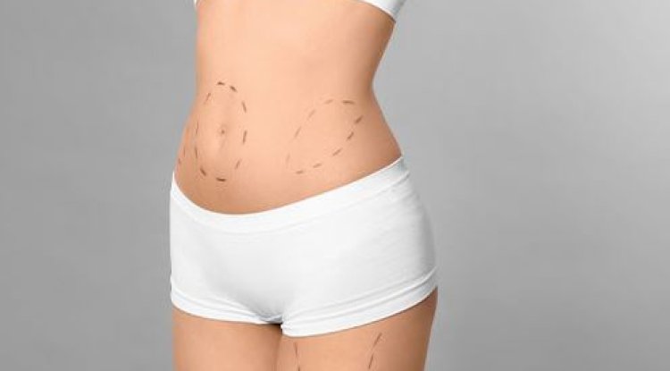 Under the Knife, Over the Top: Liposuction in the Limelight