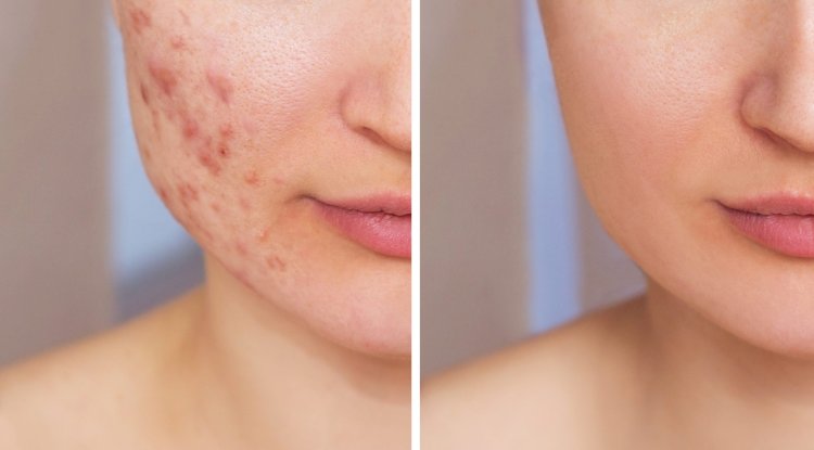 Clear Skin Journey: A Natural Approach to Managing Acne