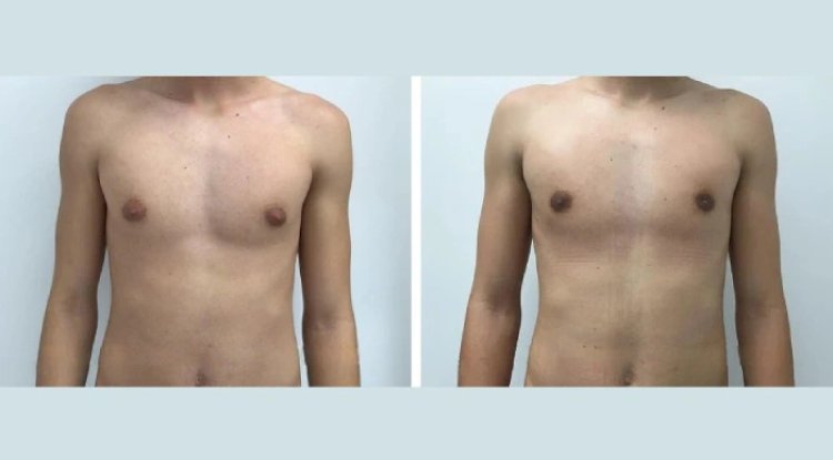 Gynecomastia in Dubai: What to Expect Before and After