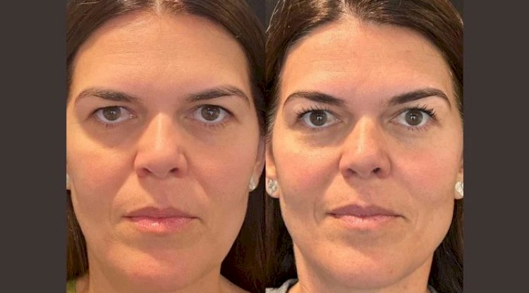 Thread Lifts Explained: Why the Best Doctors in Dubai Trust This Treatment