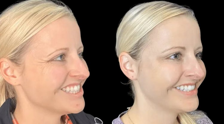 Natural-Looking Botox Results: Tips from the Best Doctors in dubai