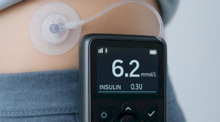 Welcome to Aidex CGM: Revolutionizing Diabetes Care with Automatic Pumps for Insulin Dependent Patients