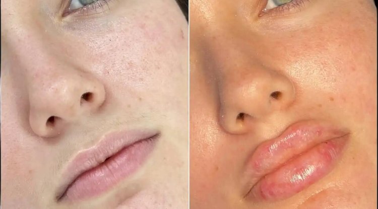 Fillers in Dubai: Restore Volume and Youthful Contours