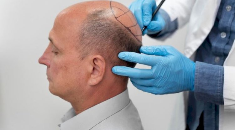 Hair Transplant Procedure for Hair Loss Treatment in Men