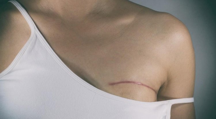 The Importance of Choosing the Right Breast Cancer Reconstruction Specialist