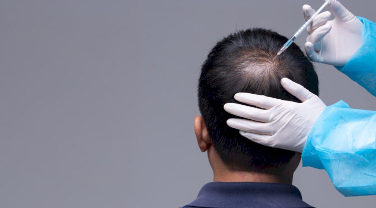 Can Minoxidil Help Regrow Hair? Detailed Insights for Men and Women