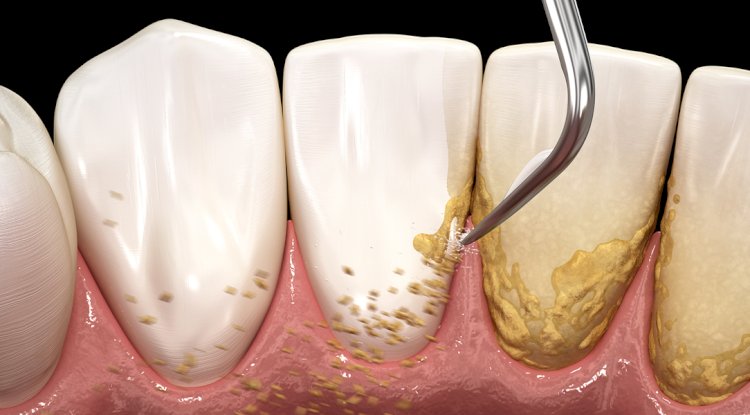 Scaling of Teeth What It Is, Why It’s Important, and How It Improves Your Oral Health