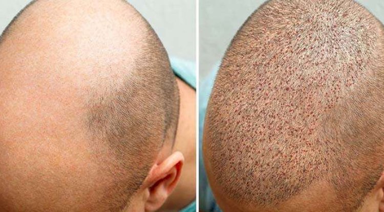 DHI Hair Restoration Albania: De Slimme Keuze voor Britten met Haarverlies