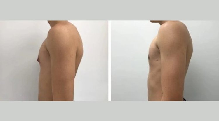 The Best Gynecomastia Surgeons in Dubai for Natural-Looking Results