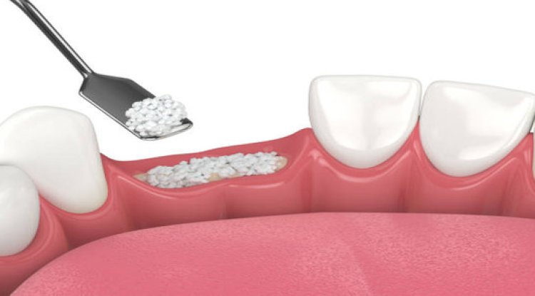 What Is Dental Bone Grafting? A Simple Explanation for Patients