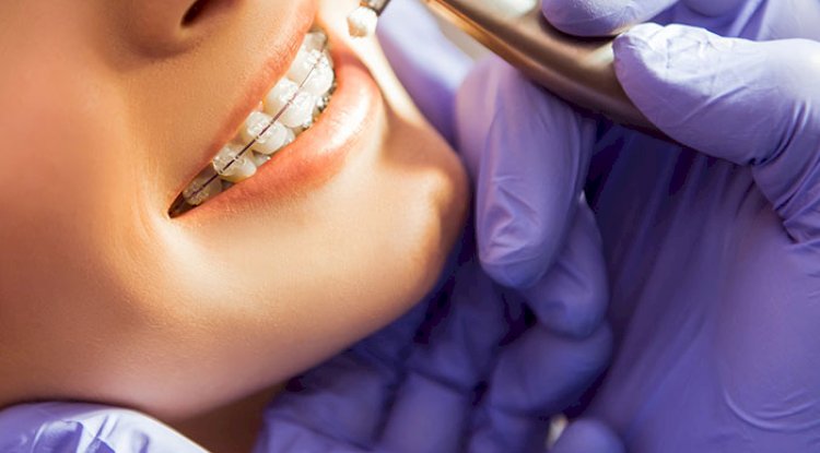 Discover Your Best Smile with Braces or Invisalign at Orb Dental in Brampton