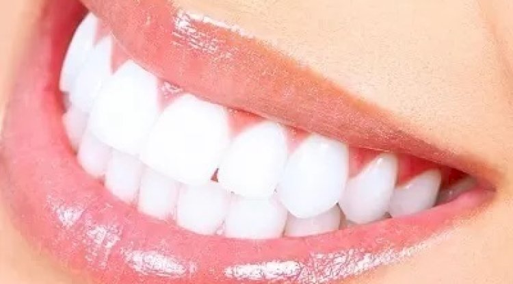 What Is Laser Teeth Whitening? A Beginner’s Guide in Islamabad