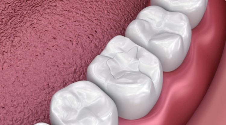 What’s the Best Filling Material for Front Teeth