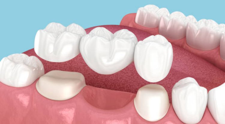 When Should You Replace an Old Dental Bridge