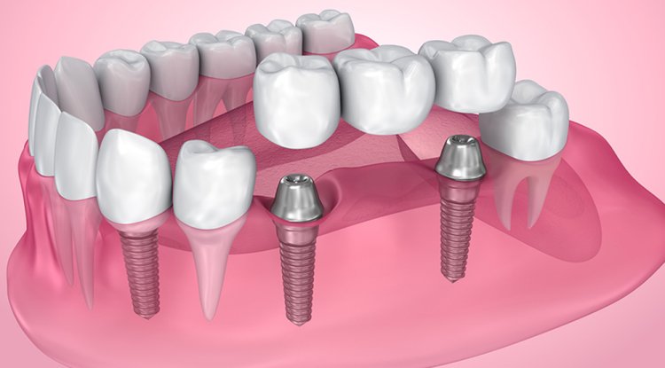 Reclaim Your Confident Smile with Dental Bridges in York: What You Need to Know