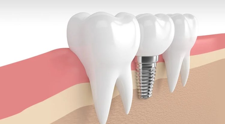 Sparkle with Every Smile Using Dental Implants in Dubai