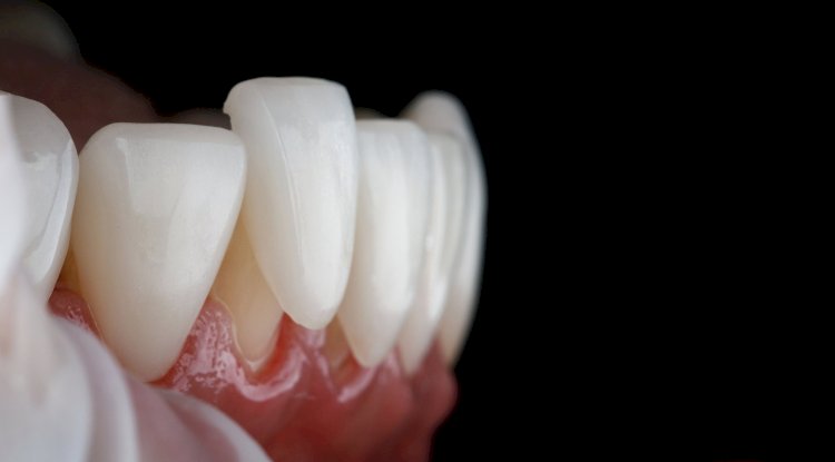 The Role of Dental Veneers in Cosmetic Dentistry: Trends and Innovations