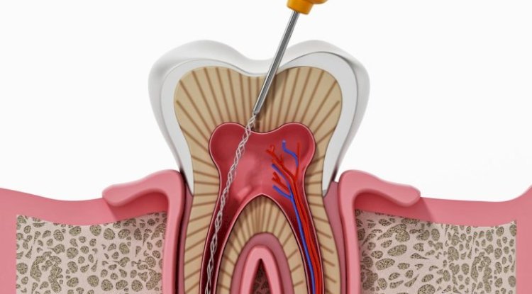 Root Canal Treatment Specialist Near Me: Expert Tooth Care at Dr. Neetu’s Multi Speciality Dental Clinic, Panchkula