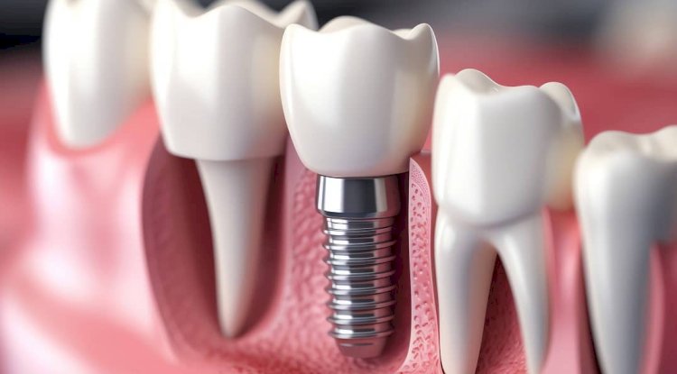 What to Expect During a Dental Implant Procedure in North York