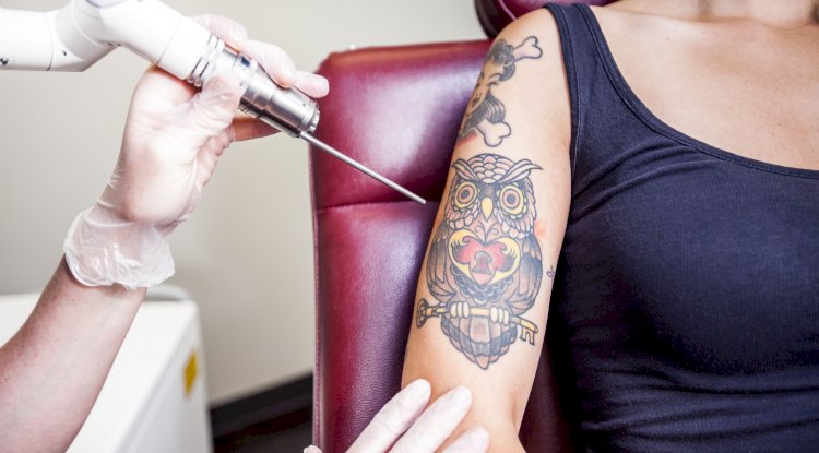 How PicoSure Laser Works: The Science Behind Tattoo Removal