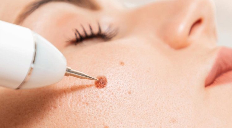 Skincare Routine After Warts Removal in Islamabad