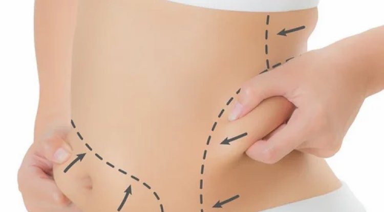 Tummy Tuck and Diastasis Recti: Real Repair for Core Muscles