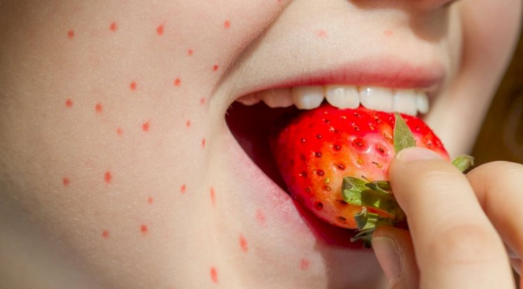 How Accurate are Food Allergy Tests in Dubai?