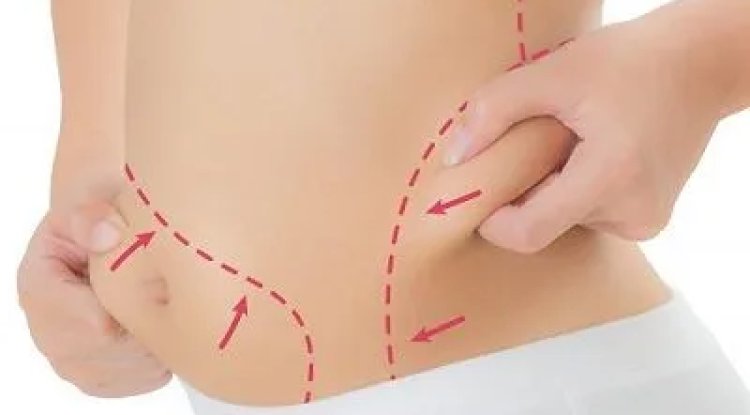 How to Estimate Your Liposuction Cost in Dubai Accurately