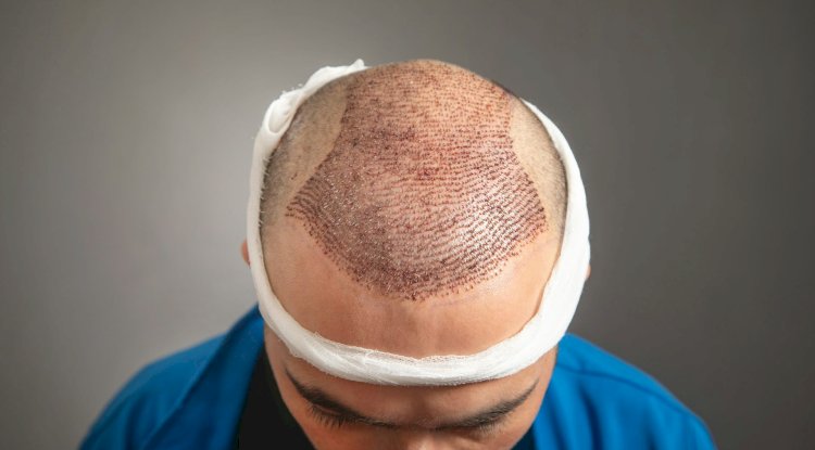 Who is the ideal candidate for a hair transplant?