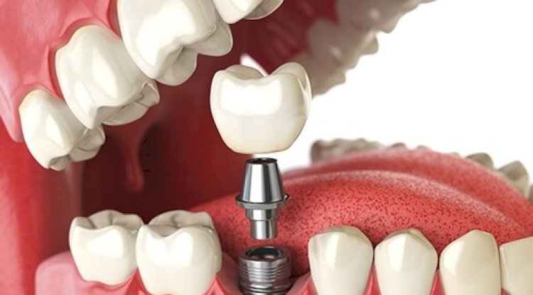 A Breakdown of Single vs. Full Mouth Dental Implants Cost in Dubai