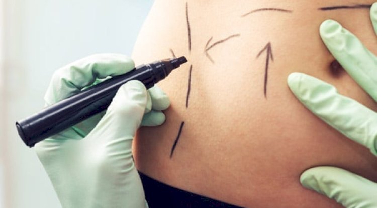 Factors That Affect Liposuction Cost in Dubai