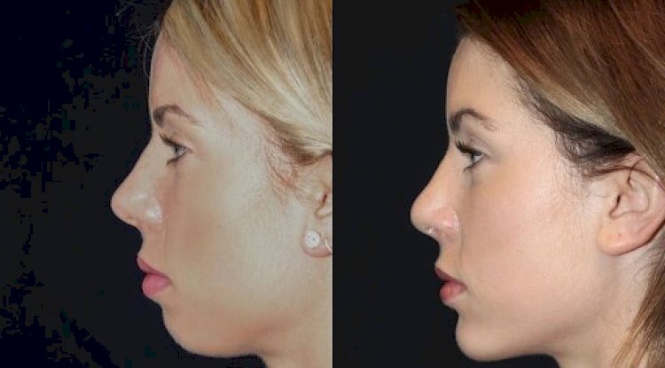 Best Plastic Surgeon in dubai for Chin Fillers: Achieve Subtle, Natural Enhancements