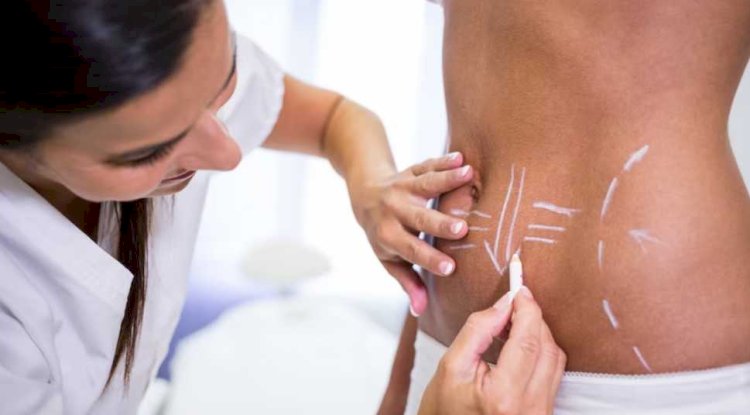 Free vs. Paid Liposuction Consultations in Islamabad