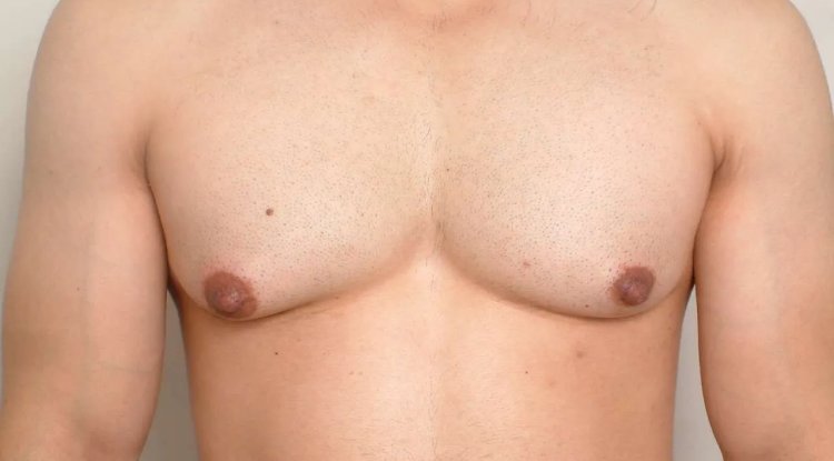 Does Weight Loss Eliminate Gynecomastia Completely?