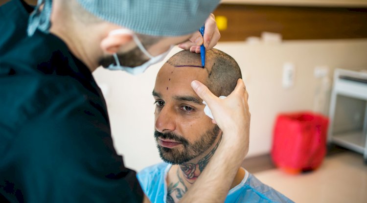 How Hair Transplants Have Evolved Over the Last Decade