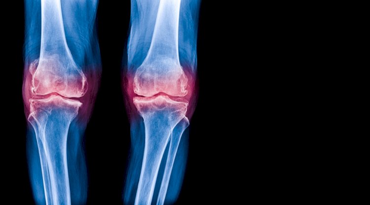 Is Sclerosis the Same as Osteoarthritis? Here’s What You Need to Know 