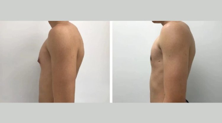 Male Boob Surgery in Dubai: Understanding the Benefits of Gynecomastia Surgery