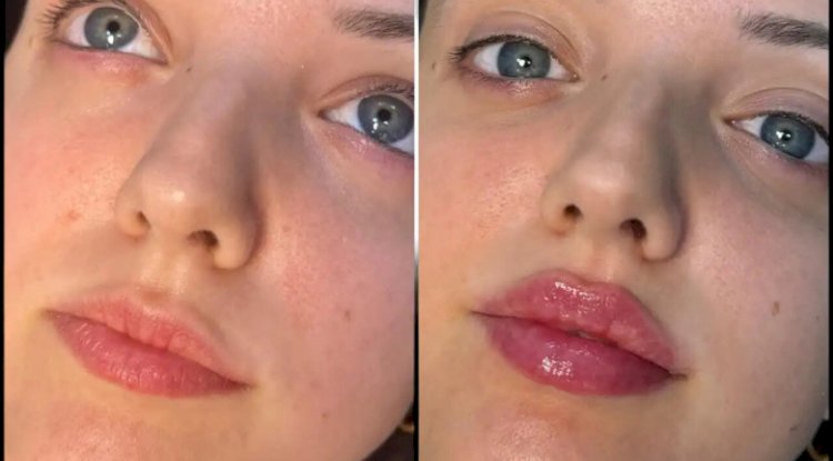 Fillers Treatments in Dubai: Making Your Jawline the Star of Your Face
